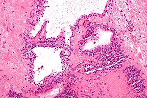 Pankreatický serózní cystadenom - vysoký mag.jpg
