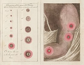 Fold out colour plate showing vaccination scars Wellcome L0041064.jpg