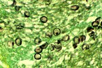 Miniatura per Pneumocystis jirovecii