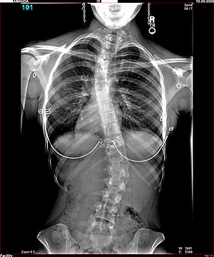 English: X-ray of U.S. girl, age 16 years 8 mo...