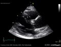 Soubor: Stenóza aortální chlopně E00122 (CardioNetworks ECHOpedia) .webm