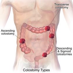 Types of colostomy.