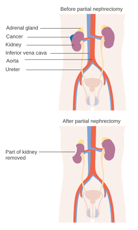 Diagram showing before and after a partial nephrectomy CRUK 102.svg