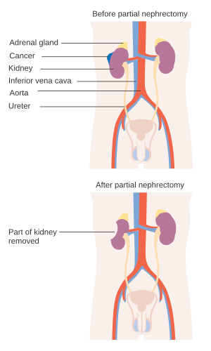 Šematizovani prikaz anatomskih struktura pre i nakon parcijalne (levo) i radikalne nefrektomije (desno)