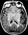 Imagen de RM en secuencia FLAIR que demuestra infiltración relacionada con tumor que involucra núcleos lenticulares (Flecha).