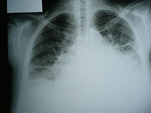 English: Medical X-rays Congestive heart failure