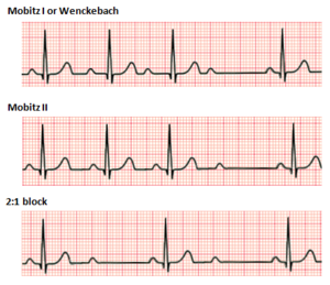 Second degree heart block.png