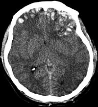 КТ-сканування, на якому видно забиття мозку, геморрагію у півкулях, субдуральну гематому та перелом черепа.