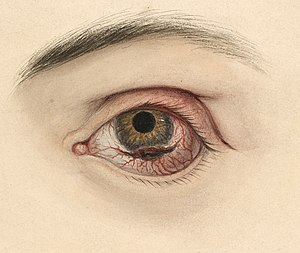 Eye with a melanotic sarcoma Wellcome L0061861.jpg