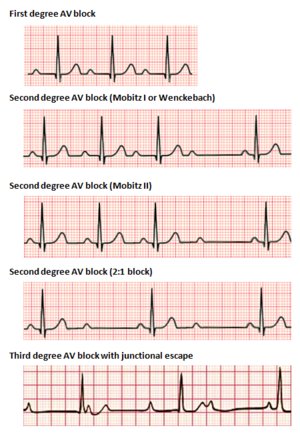 Heart block.png