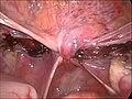 Fase finale di un'isterectomia laparoscopica