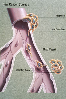 رسم توضيحي يظهر انبثاث دموي المنشأ