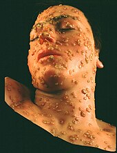 European colonization introduced smallpox, devastating the indigenous populations of the Americas Wax model of smallpox lesions on the face of a 15 year old boy.jpg