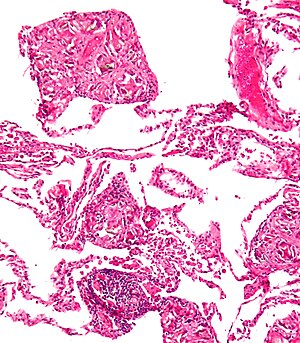 Pulmonary talcosis low mag cropped.jpg