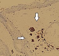 Imunohistohemijski nalaz SOX10 u dermnom nevusu ima pozitivno obojene ćelije nevusa (strelice)