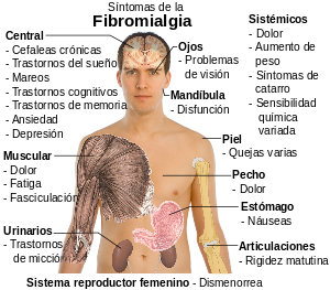 English: Common signs and symptoms of fibromya...