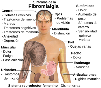 Sintomas de la fibromialgia-es.svg