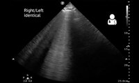 File:UOTW 36 - Ultrasound of the Week 2.webm