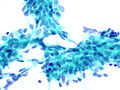 Fibroadenom – vzorec, pridobljen s tankoigelno biopsijo (barvanje po Papanicolaouu). Slika prikazuje sloj epitelijskih celic v značilnem rogovilastem vzorcu.