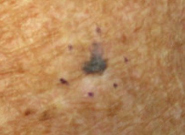 Malignant Melanoma, left forearm marked for biopsy (Original Post: Shared in Melanoma)