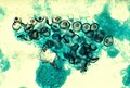 Pneumocystis carinii ind smear from BAL 01ee046 lores.jpg