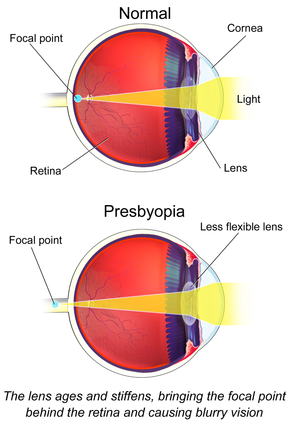 Presbyopia Presbyopia.png
