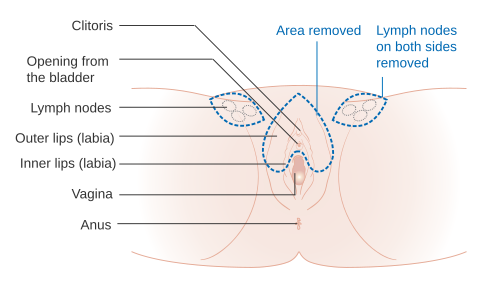 Una vulvectomia parcial de la zona superior de la vulva