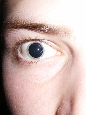 English: Dilated pupils after an optometrist a...