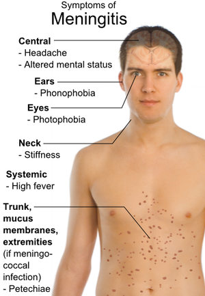 English: Main symptoms of Meningitis. Referenc...