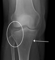 A tibial plateau fracture seen on X-ray