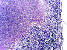 Microscopy of tuberculous epididymitis. H&E stain Tuberculous epididymitis Low Power.jpg