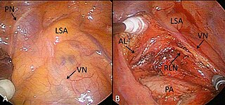 Single-Port videoassistierte Thorakoskopie (VATS) zur Lungenlobektomie. Videobild während der Operation mit Blick vom linken unteren Mediastinum.[7]