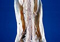 1. Ligamentum denticulatum, 2. Arachnoidea mater spinalis, 3. Dura mater spinalis, 4. Arteria spinalis anterior, 5. Nervus spinalis, Radix anterior.