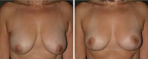 English: Breast reduction: pre-operative and p...