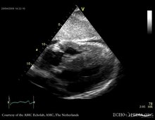 Файл: амилоидоз с тяжелым поражением сердца E00109 (CardioNetworks ECHOpedia) .webm