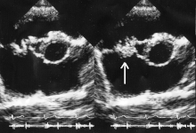 Infective Endocarditis Treatment Guidelines Nice