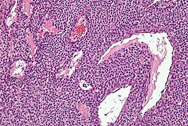 Glomus tumour - high mag.jpg