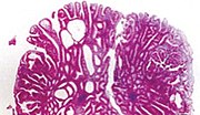 Micrograph of tubulovillous adenoma.jpg