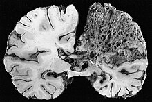 This coronal cross-section of a brain reveals a significant arteriovenous malformation that occupies much of the parietal lobe. AVM grossly.jpg