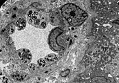 TEM-Aufnahme von den Endothelien und Zellen der glatten Muskulatur einer Nierenarteriole mit Inklusionen von Glycosphingolipiden