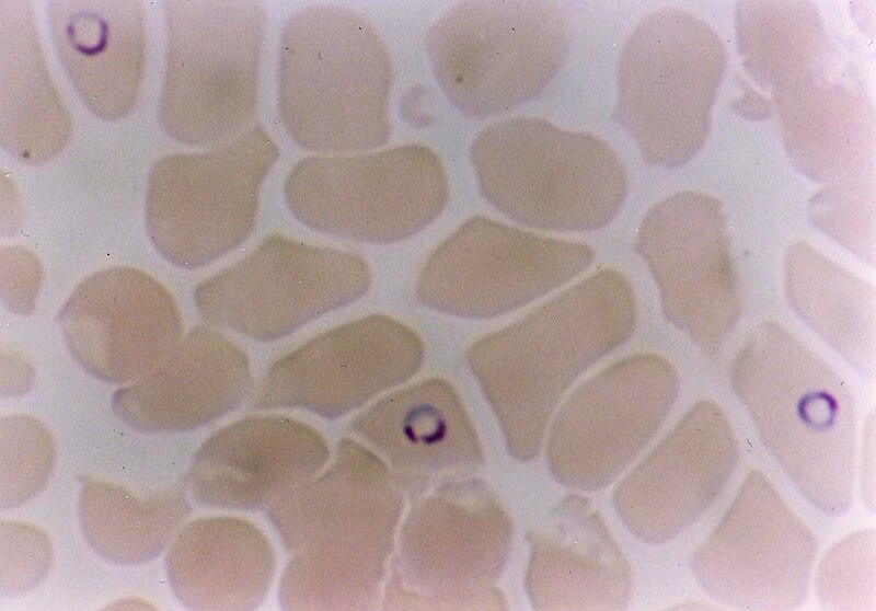 File:Plasmodium falciparum in Red Blood Cells.jpg