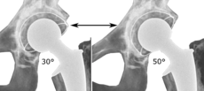 Acetabular inclination is normally between 30 and 50°.[80] A larger angle increases the risk of dislocation.[9]