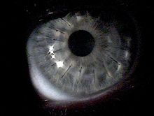 corneal images