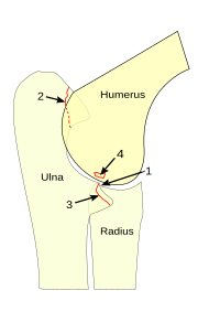 Typische ED-Manifestationen 1 Stufenbildung zwischen Elle (Ulna) und Speiche (Radius) 2 Isolierter Processus anconaeus 3 Fragmentierter Processus coronoideus medialis 4 OCD des medialen Condylus