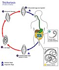Миниатюра для Трихоцефалёз