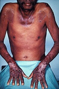 Pellagra initially presents as dermatitis Pellagra2.jpg