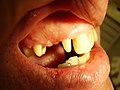 Präparierte Zahnstümpfe der Zähne 11, 14 und 16 mit Hohlkehl-Präparation unterhalb des Zahnfleischsaumes