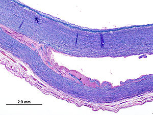 Histopathological image of dissecting aneurysm...