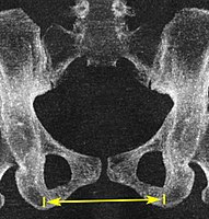 Low dose CT for pelvimetry