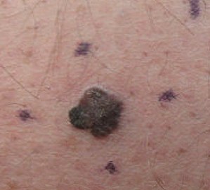 Malignant Melanoma, right medial thigh marked for biopsy (Original Post: Shared in Melanoma)